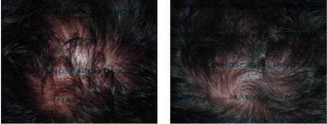 Мезотерапия для восстановления роста волос