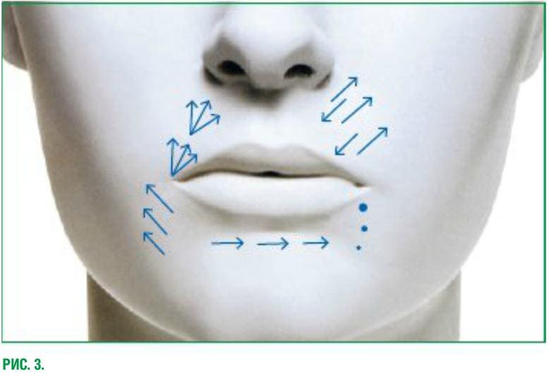 Техника с использованием игл для коррекции носогубных складок и углов рта