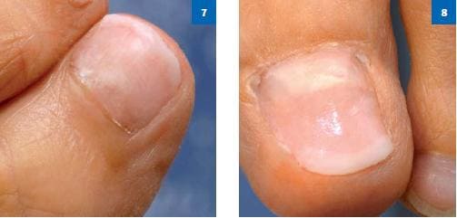 Процедура протезирования ногтей на ногах
